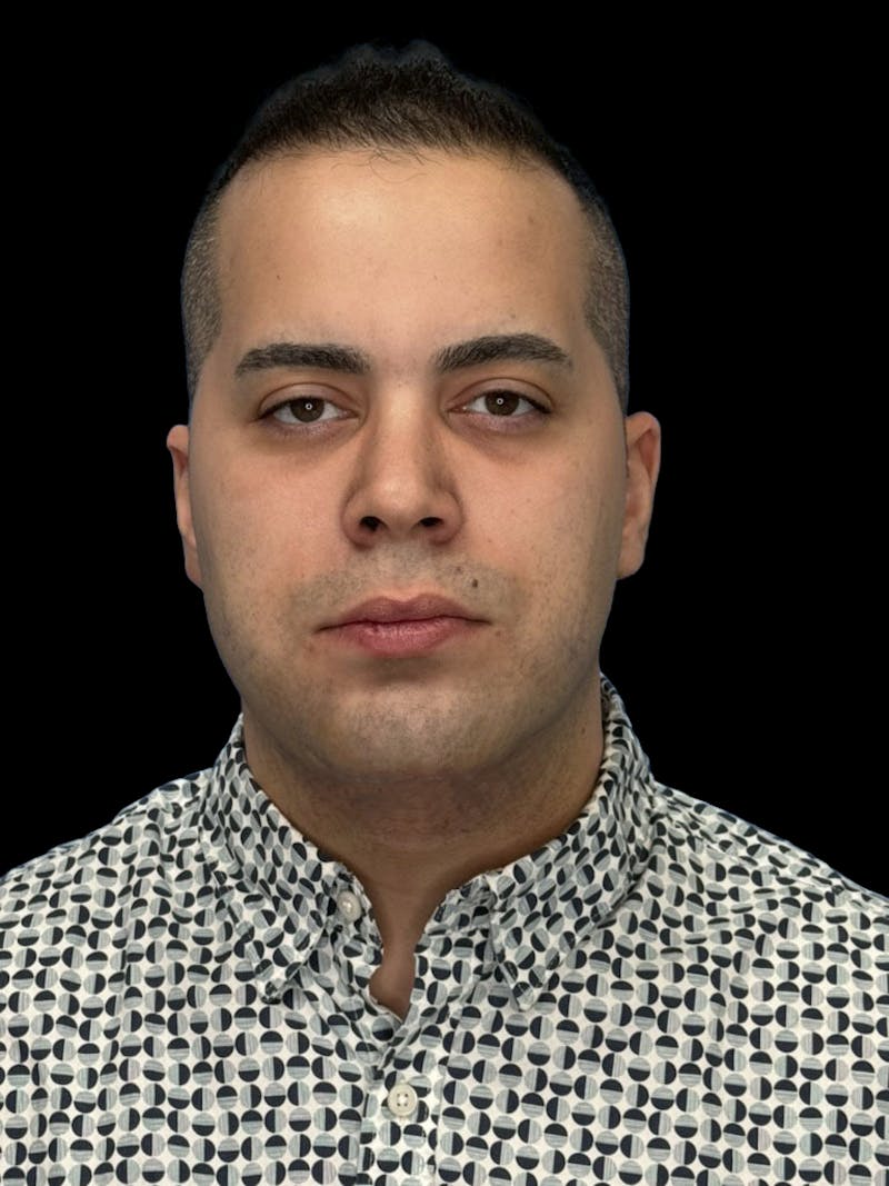 Neck Lift Before & After Gallery - Patient 360884 - Image 2