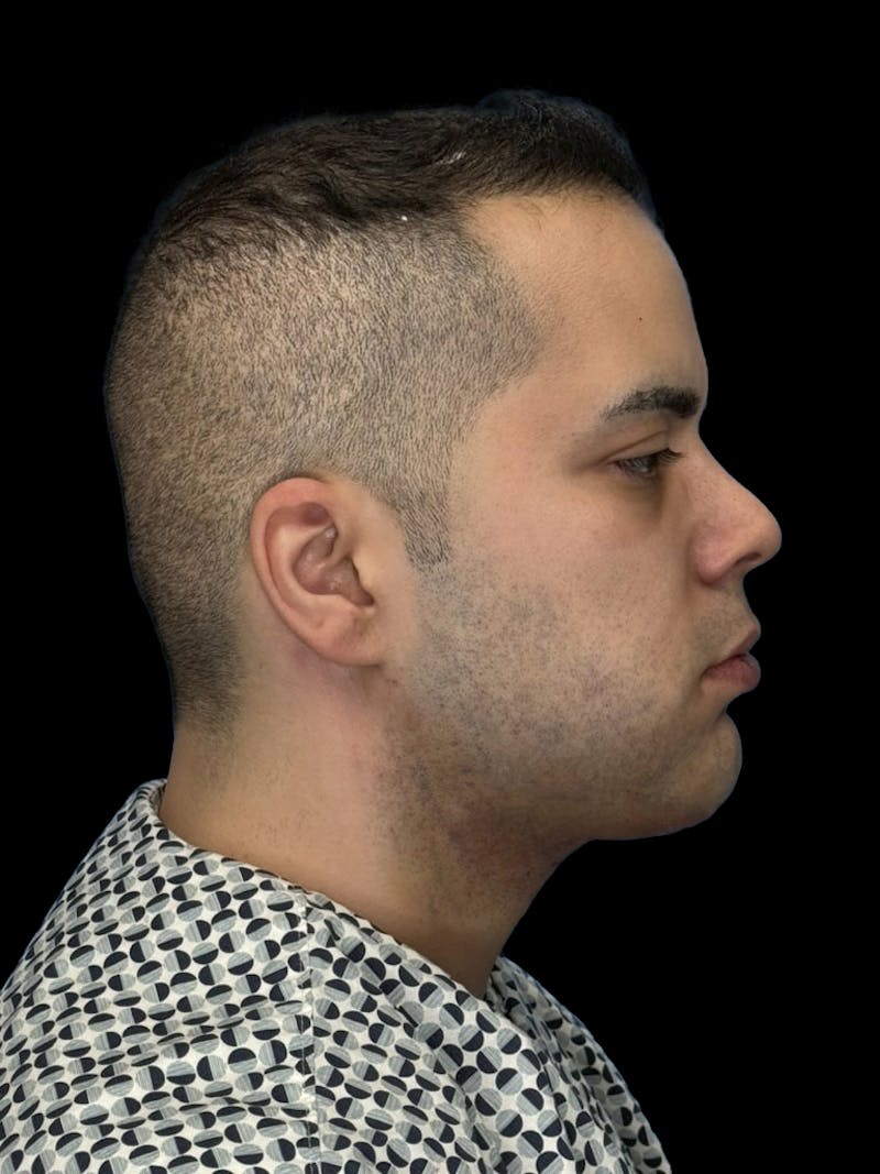 Neck Lift Before & After Gallery - Patient 360884 - Image 8
