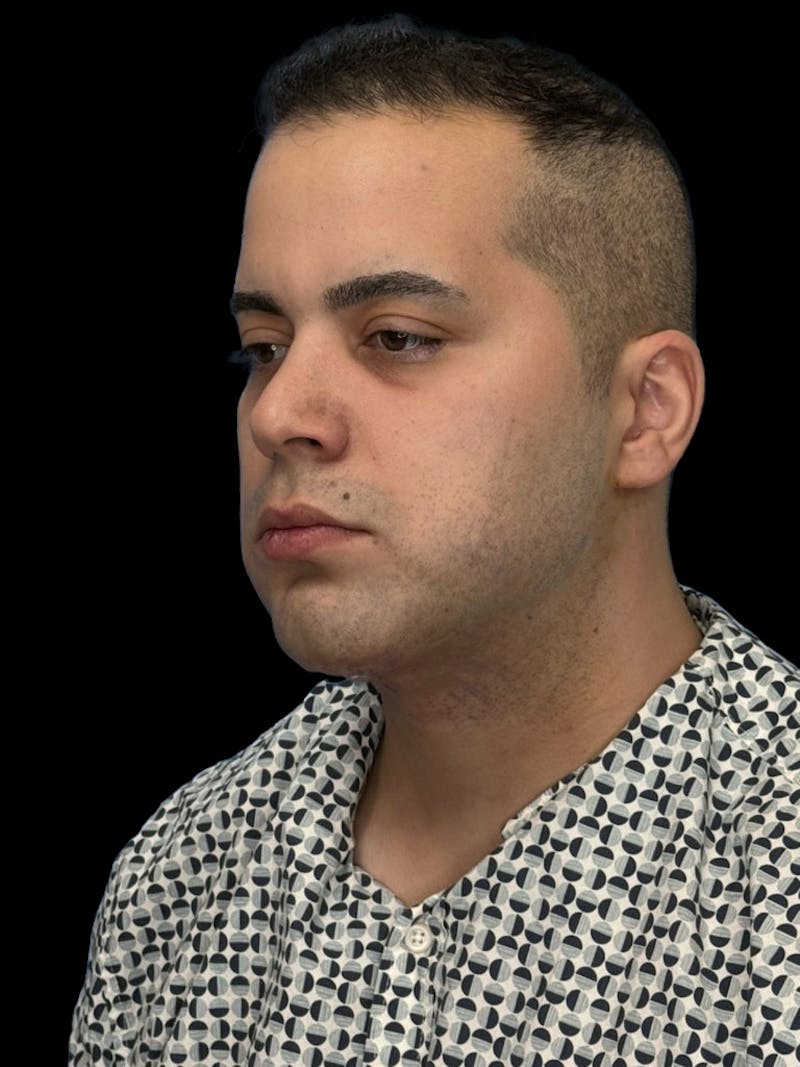 Neck Lift Before & After Gallery - Patient 360884 - Image 4
