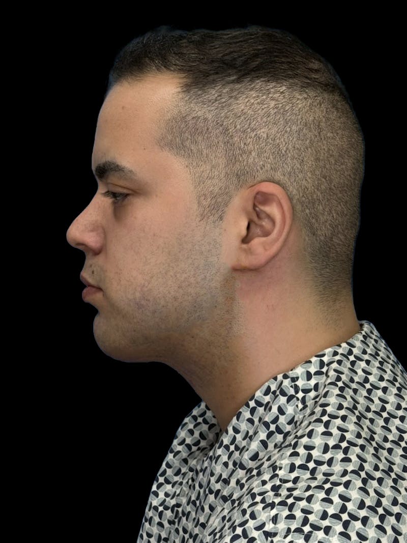 Neck Lift Before & After Gallery - Patient 360884 - Image 6
