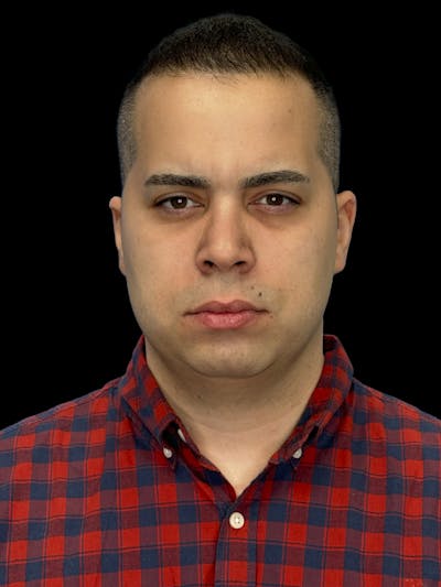 Neck Lift Before & After Gallery - Patient 360884 - Image 1