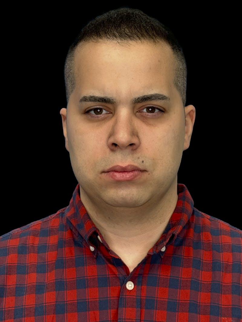 Neck Lift Before & After Gallery - Patient 360884 - Image 1