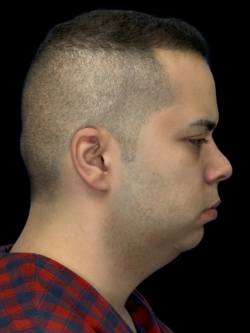 Neck Lift Before & After Gallery - Patient 360884 - Image 7