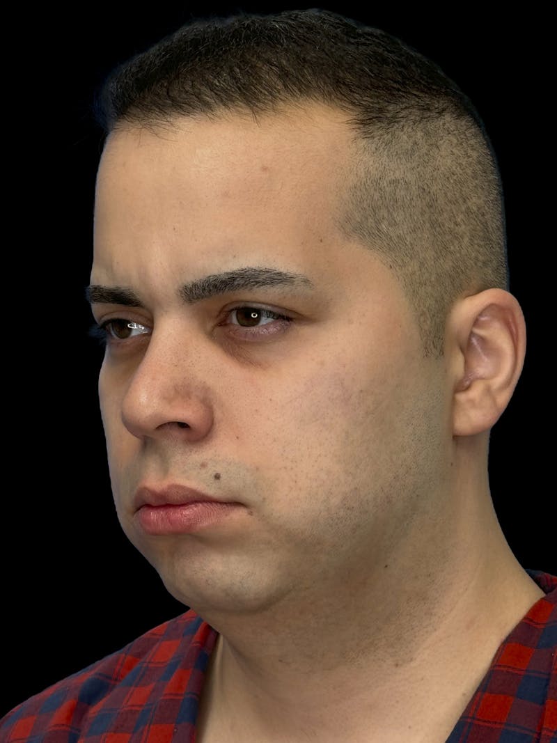 Neck Lift Before & After Gallery - Patient 360884 - Image 3