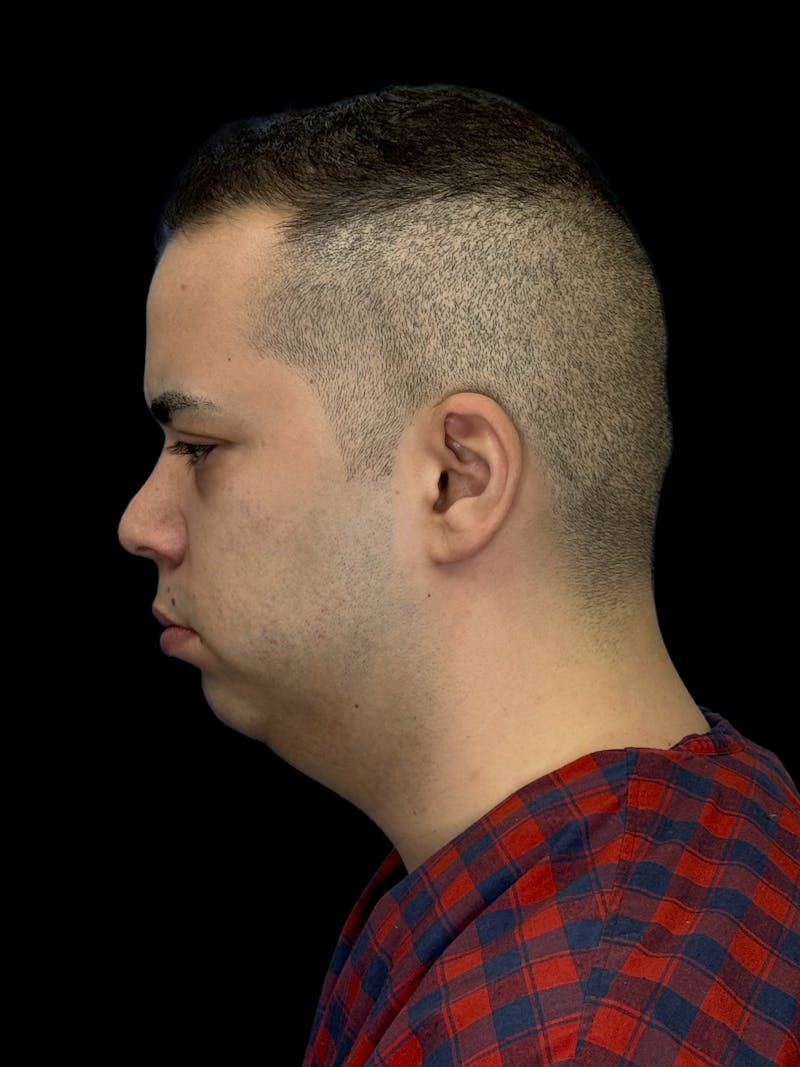 Neck Lift Before & After Gallery - Patient 360884 - Image 5
