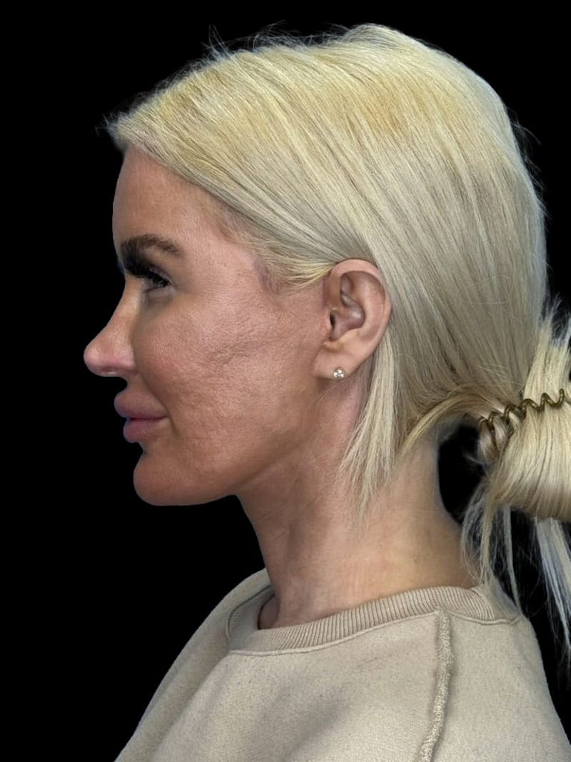 Mini Deep Plane Facelift Before & After Gallery - Patient 168883 - Image 10