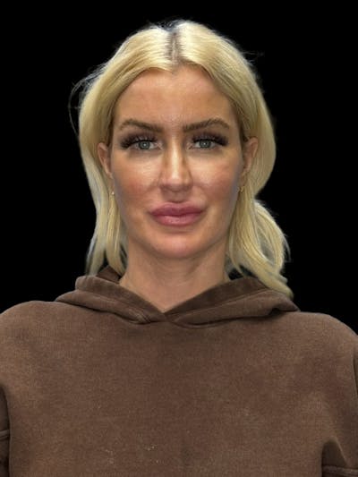 Mini Deep Plane Facelift Before & After Gallery - Patient 168883 - Image 2