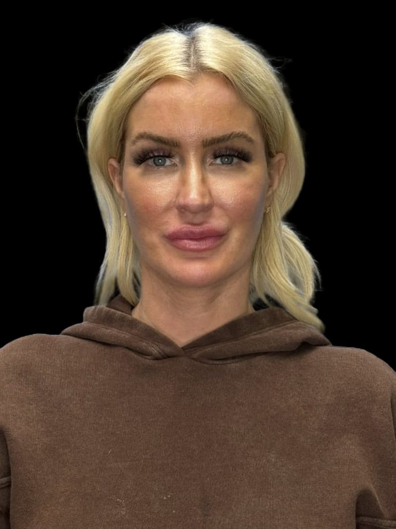 Mini Deep Plane Facelift Before & After Gallery - Patient 168883 - Image 2