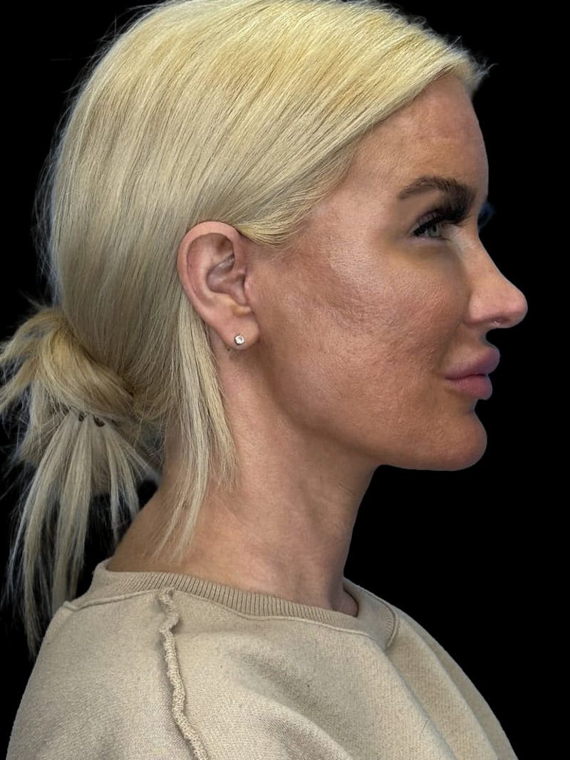 Mini Deep Plane Facelift Before & After Gallery - Patient 168883 - Image 6