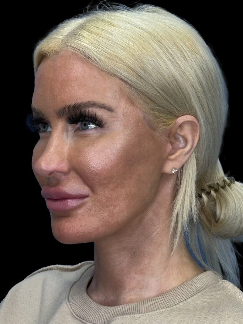 Mini Deep Plane Facelift Before & After Gallery - Patient 168883 - Image 8
