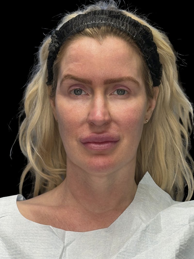 Mini Deep Plane Facelift Before & After Gallery - Patient 168883 - Image 1