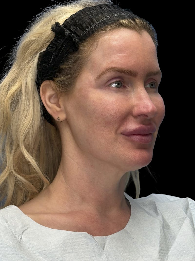 Mini Deep Plane Facelift Before & After Gallery - Patient 168883 - Image 3