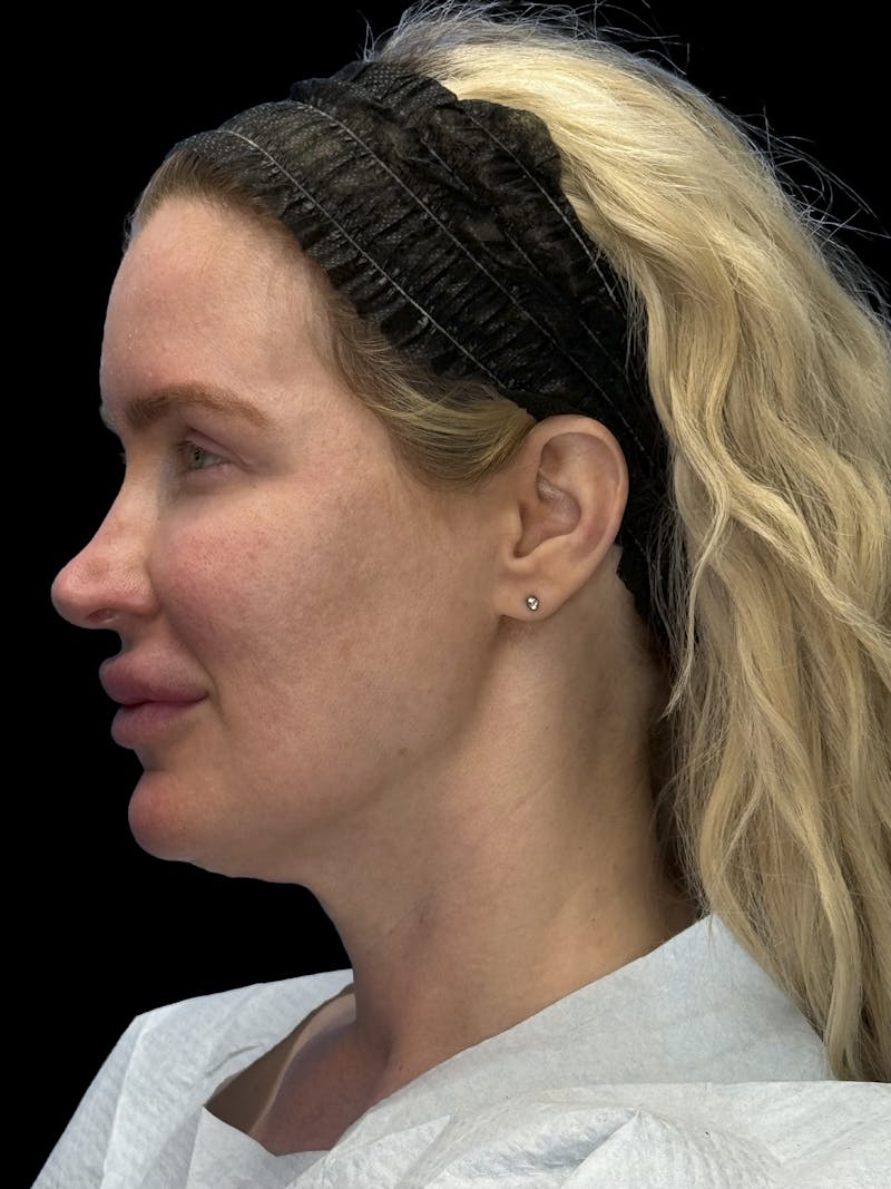 Mini Deep Plane Facelift Before & After Gallery - Patient 168883 - Image 9