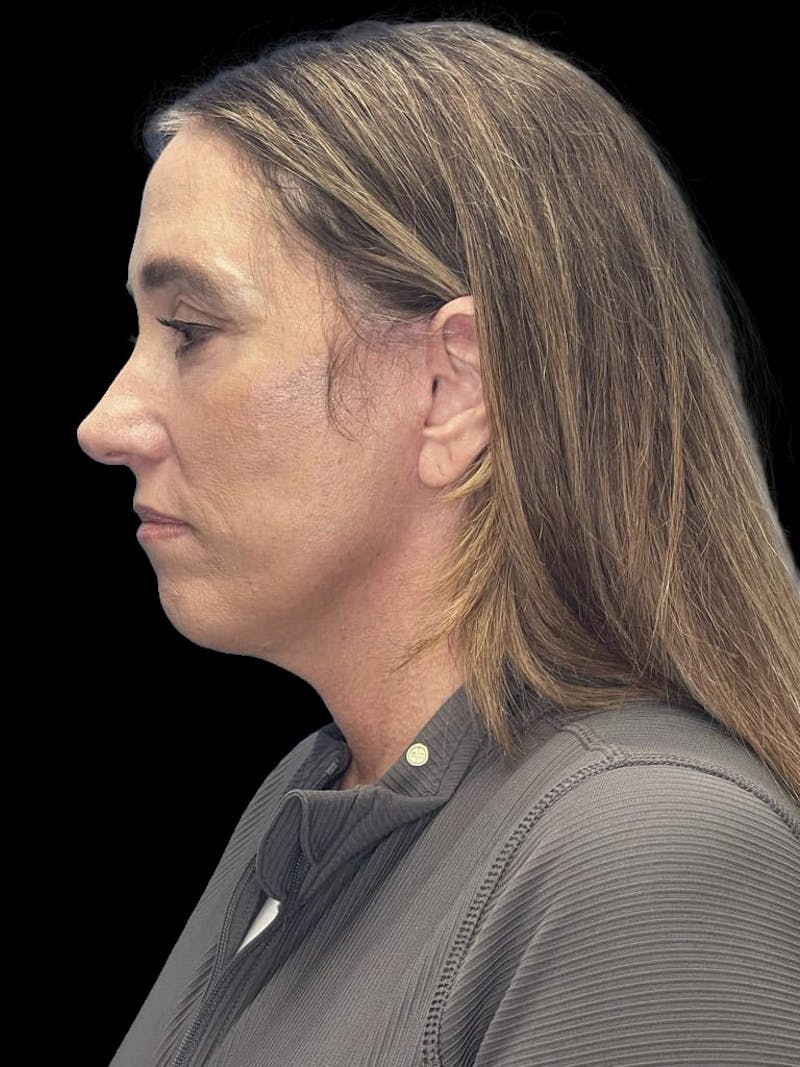 Mini Deep Plane Facelift Before & After Gallery - Patient 506348 - Image 6