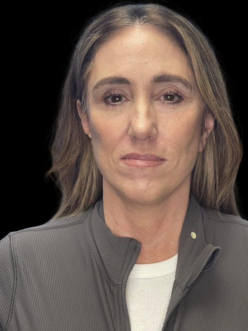 Mini Deep Plane Facelift Before & After Gallery - Patient 506348 - Image 2