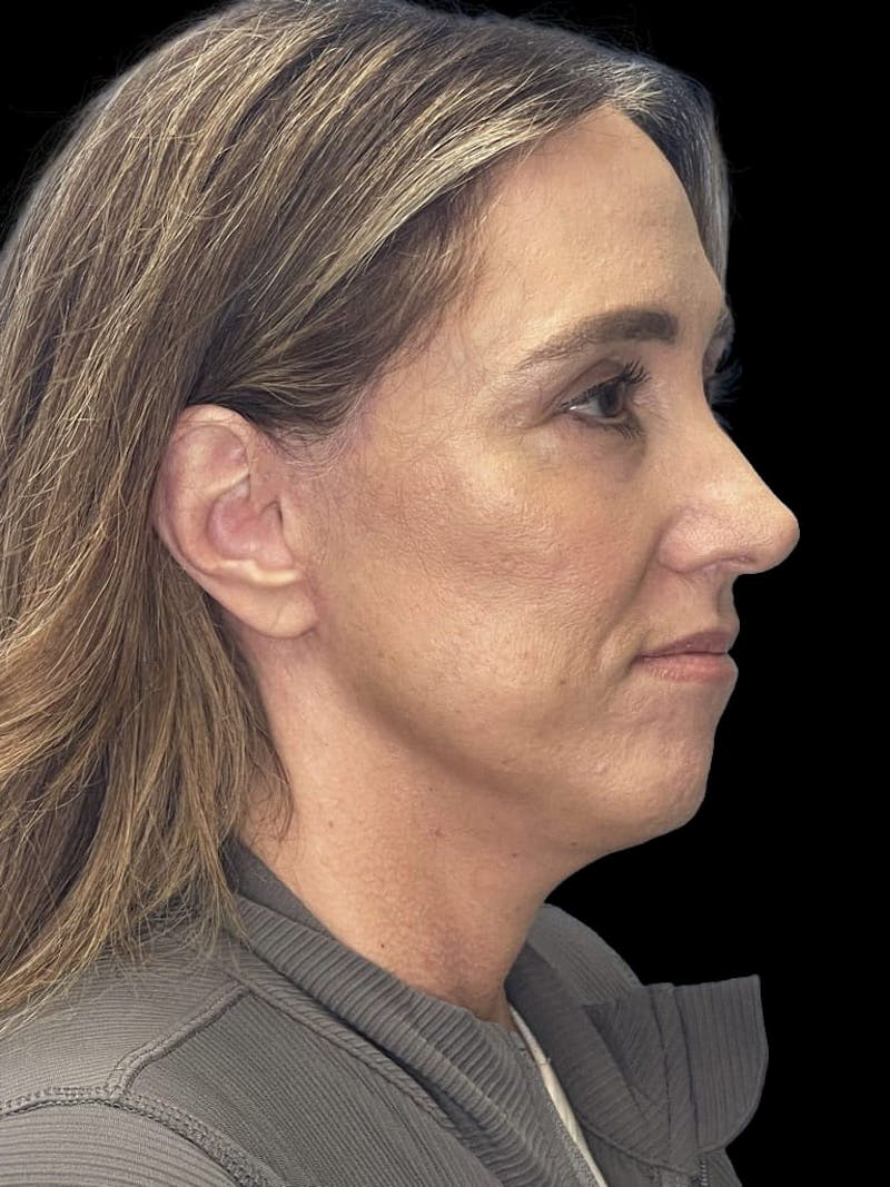 Mini Deep Plane Facelift Before & After Gallery - Patient 506348 - Image 10