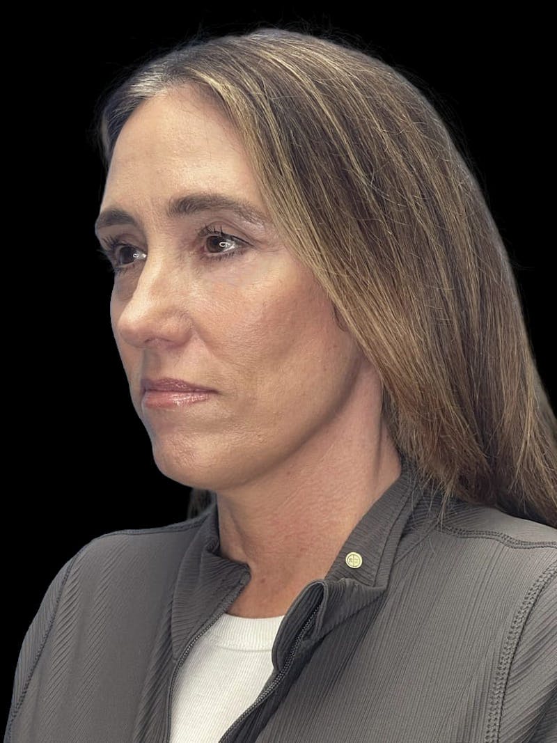 Mini Deep Plane Facelift Before & After Gallery - Patient 506348 - Image 4