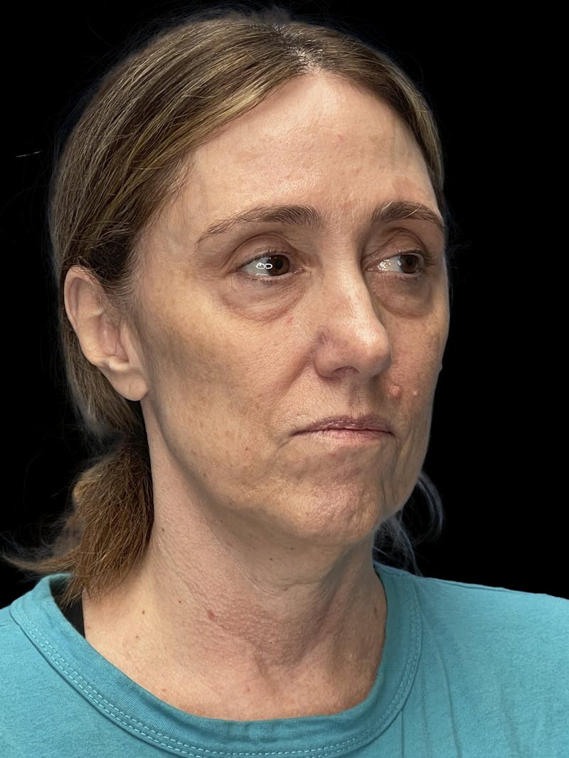 Mini Deep Plane Facelift Before & After Gallery - Patient 506348 - Image 7