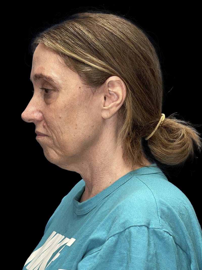 Mini Deep Plane Facelift Before & After Gallery - Patient 506348 - Image 5