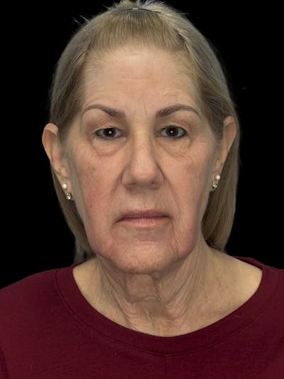 Lower Eye Rejuvenation Before & After Gallery - Patient 131341 - Image 1