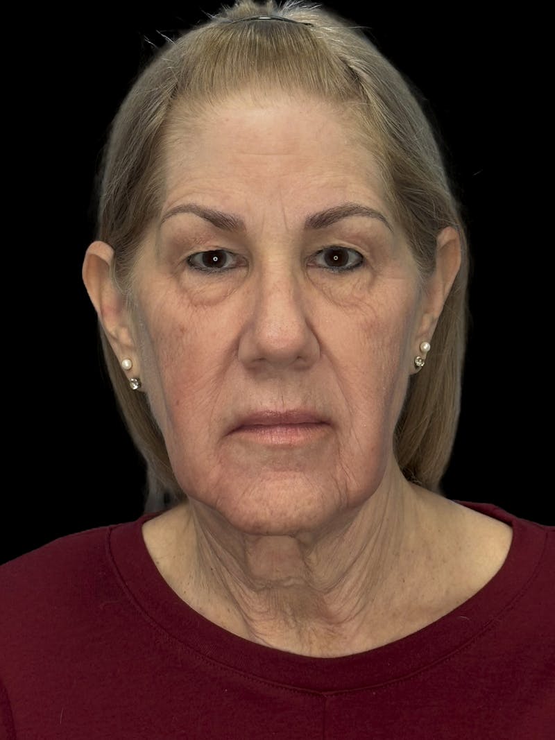 Lower Eye Rejuvenation Before & After Gallery - Patient 131341 - Image 1