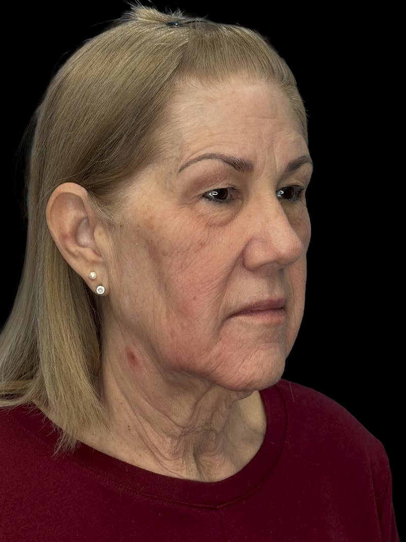 Lower Eye Rejuvenation Before & After Gallery - Patient 131341 - Image 3