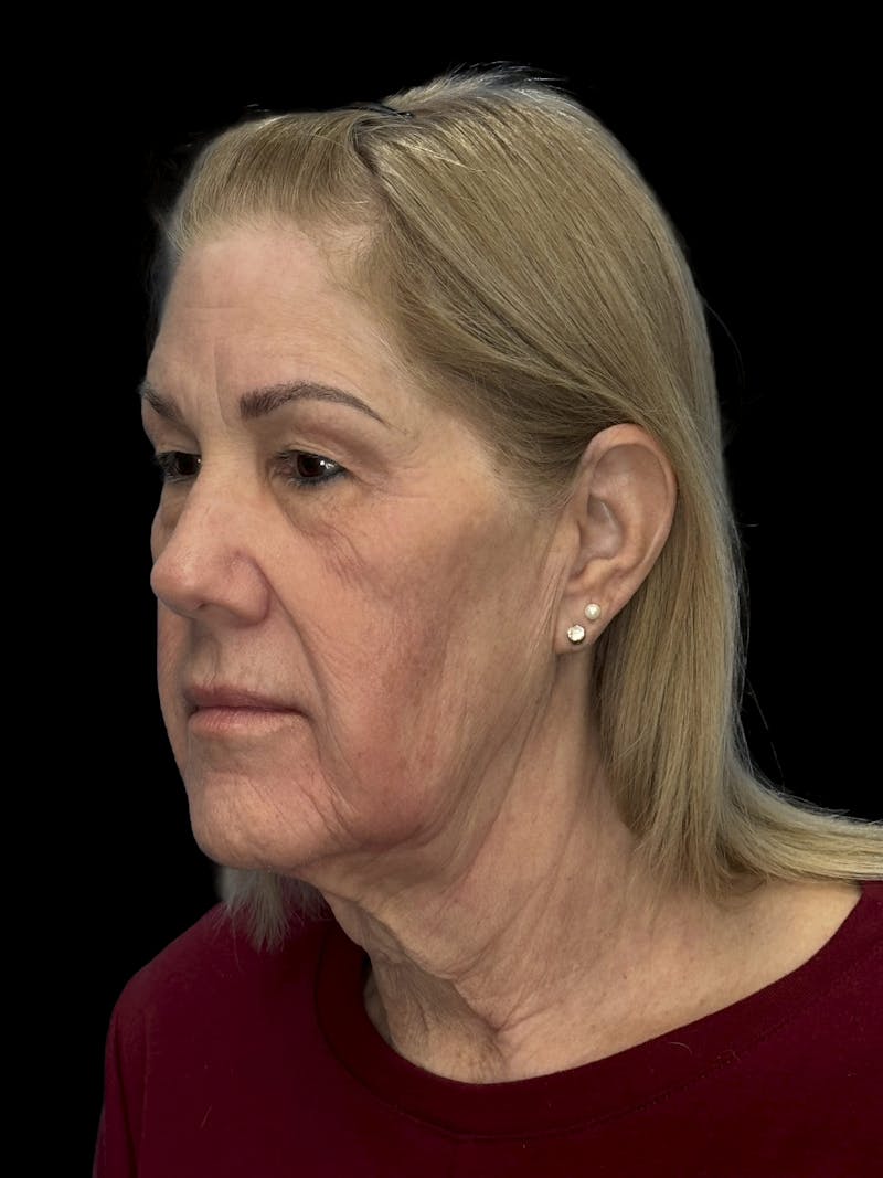 Lower Eye Rejuvenation Before & After Gallery - Patient 131341 - Image 5