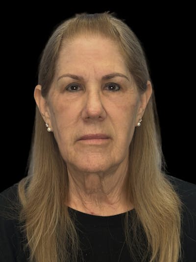 Lower Eye Rejuvenation Before & After Gallery - Patient 131341 - Image 2