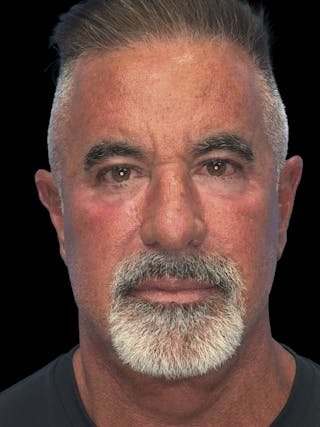 Lower Eye Rejuvenation Before & After Gallery - Patient 146934 - Image 2