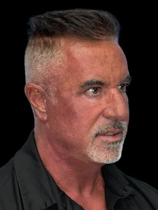 Lower Eye Rejuvenation Before & After Gallery - Patient 146934 - Image 6