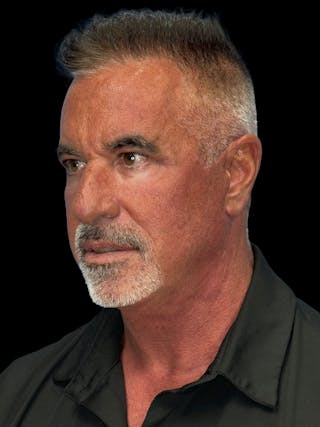 Lower Eye Rejuvenation Before & After Gallery - Patient 146934 - Image 4