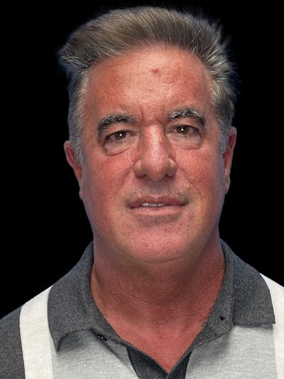 Lower Eye Rejuvenation Before & After Gallery - Patient 146934 - Image 1