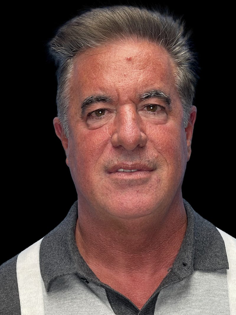 Lower Eye Rejuvenation Before & After Gallery - Patient 146934 - Image 1