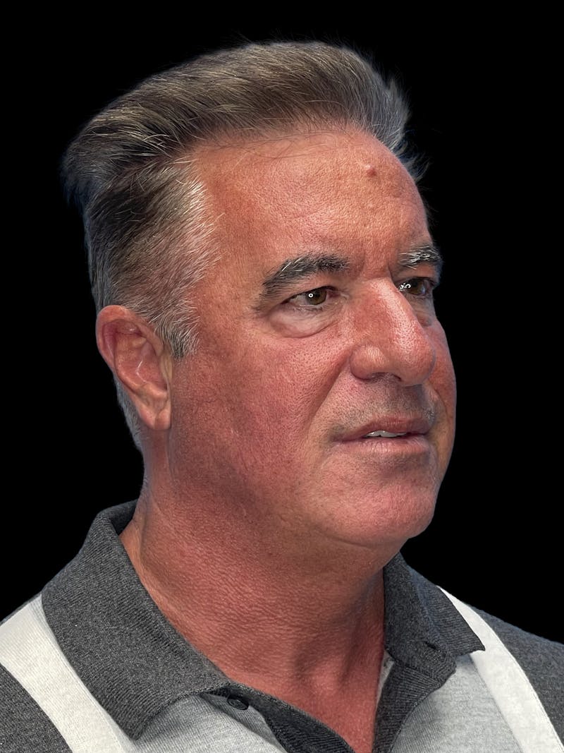 Lower Eye Rejuvenation Before & After Gallery - Patient 146934 - Image 5