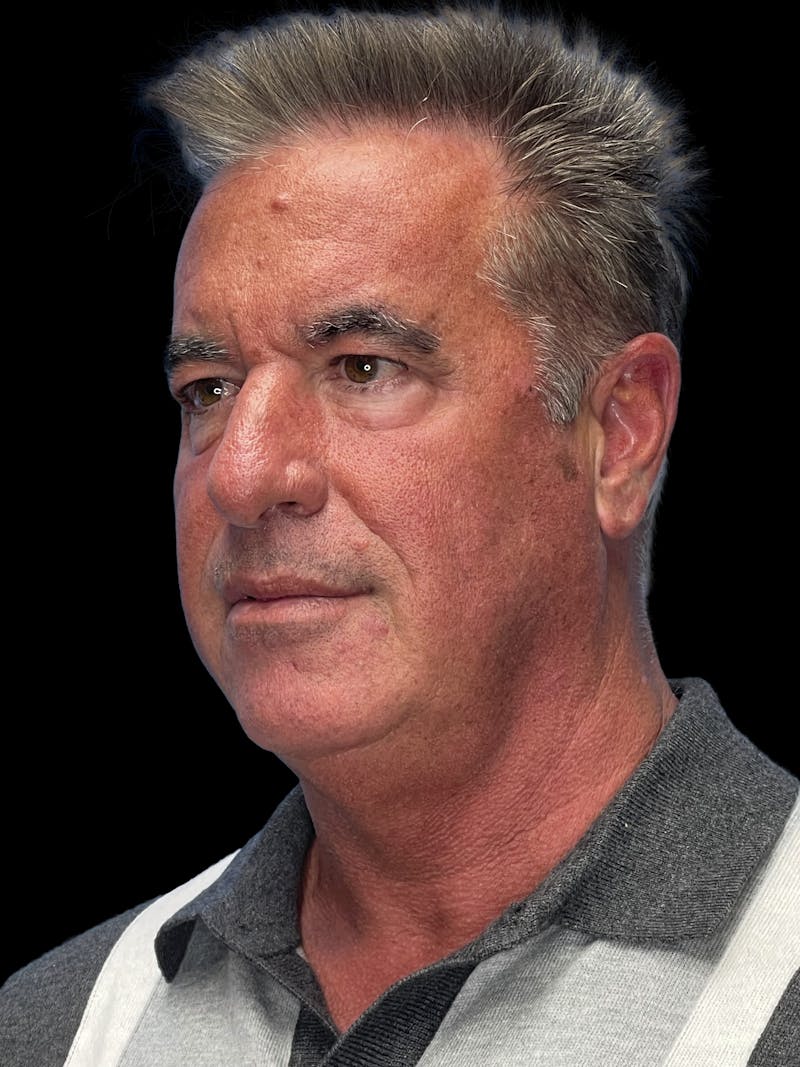Lower Eye Rejuvenation Before & After Gallery - Patient 146934 - Image 3