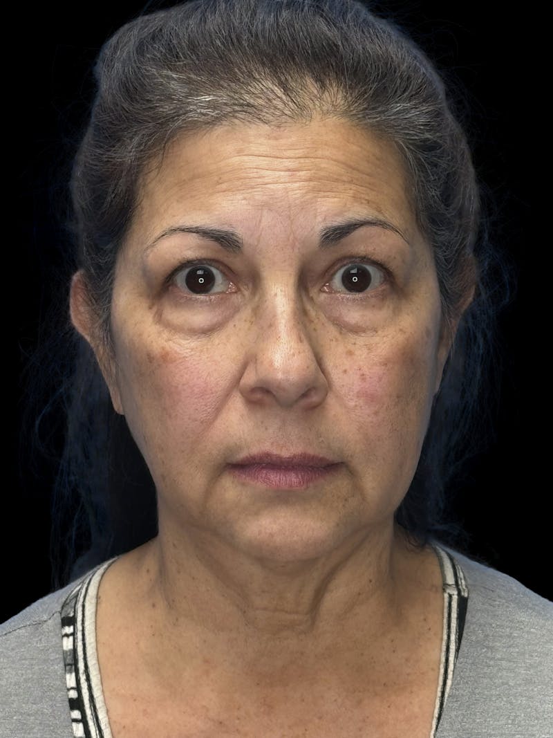 Lower Eye Rejuvenation Before & After Gallery - Patient 257457 - Image 1