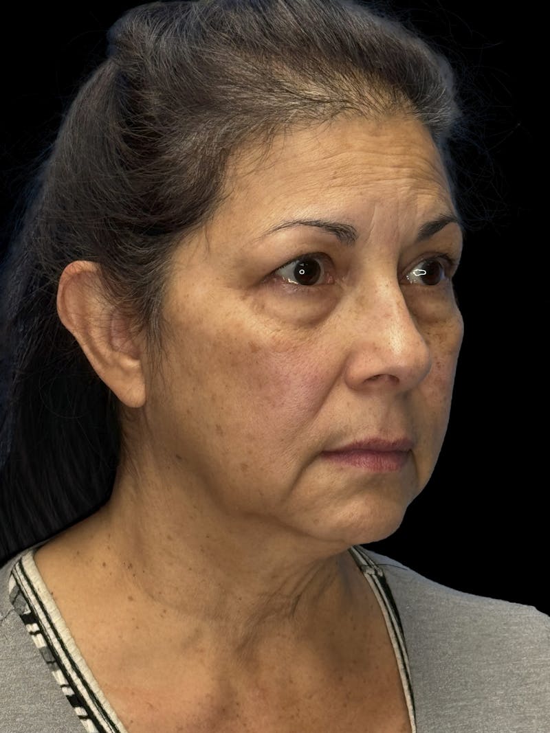Lower Eye Rejuvenation Before & After Gallery - Patient 257457 - Image 5