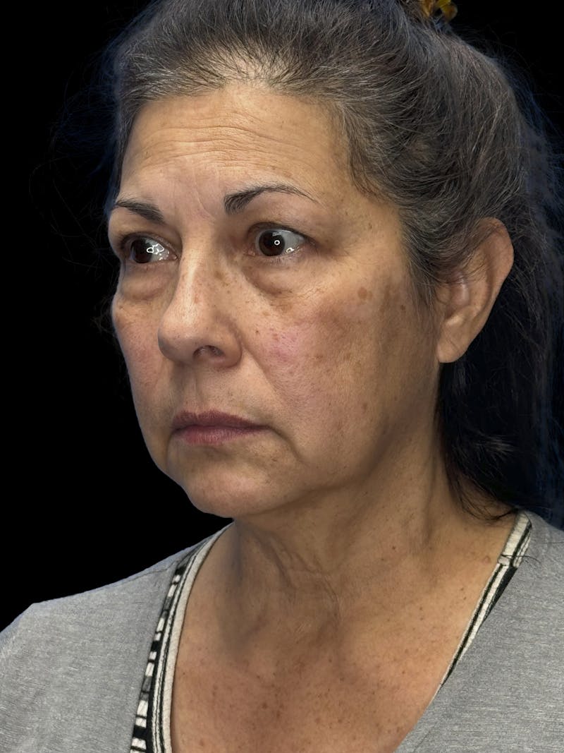 Lower Eye Rejuvenation Before & After Gallery - Patient 257457 - Image 3