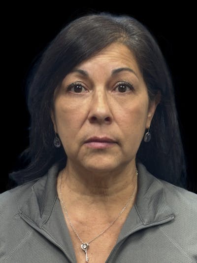 Lower Eye Rejuvenation Before & After Gallery - Patient 257457 - Image 2