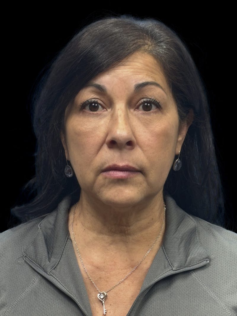 Lower Eye Rejuvenation Before & After Gallery - Patient 257457 - Image 2