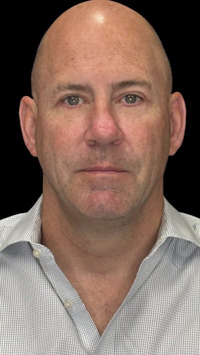 Lower Eye Rejuvenation Before & After Gallery - Patient 262198 - Image 2