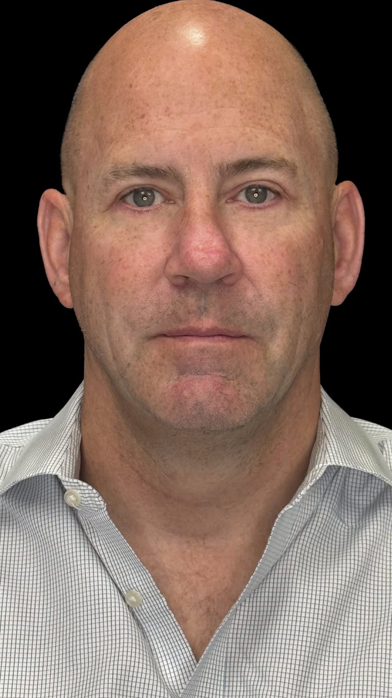 Lower Eye Rejuvenation Before & After Gallery - Patient 262198 - Image 2