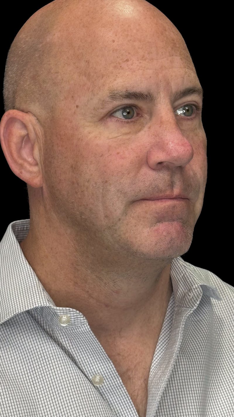 Lower Eye Rejuvenation Before & After Gallery - Patient 262198 - Image 4