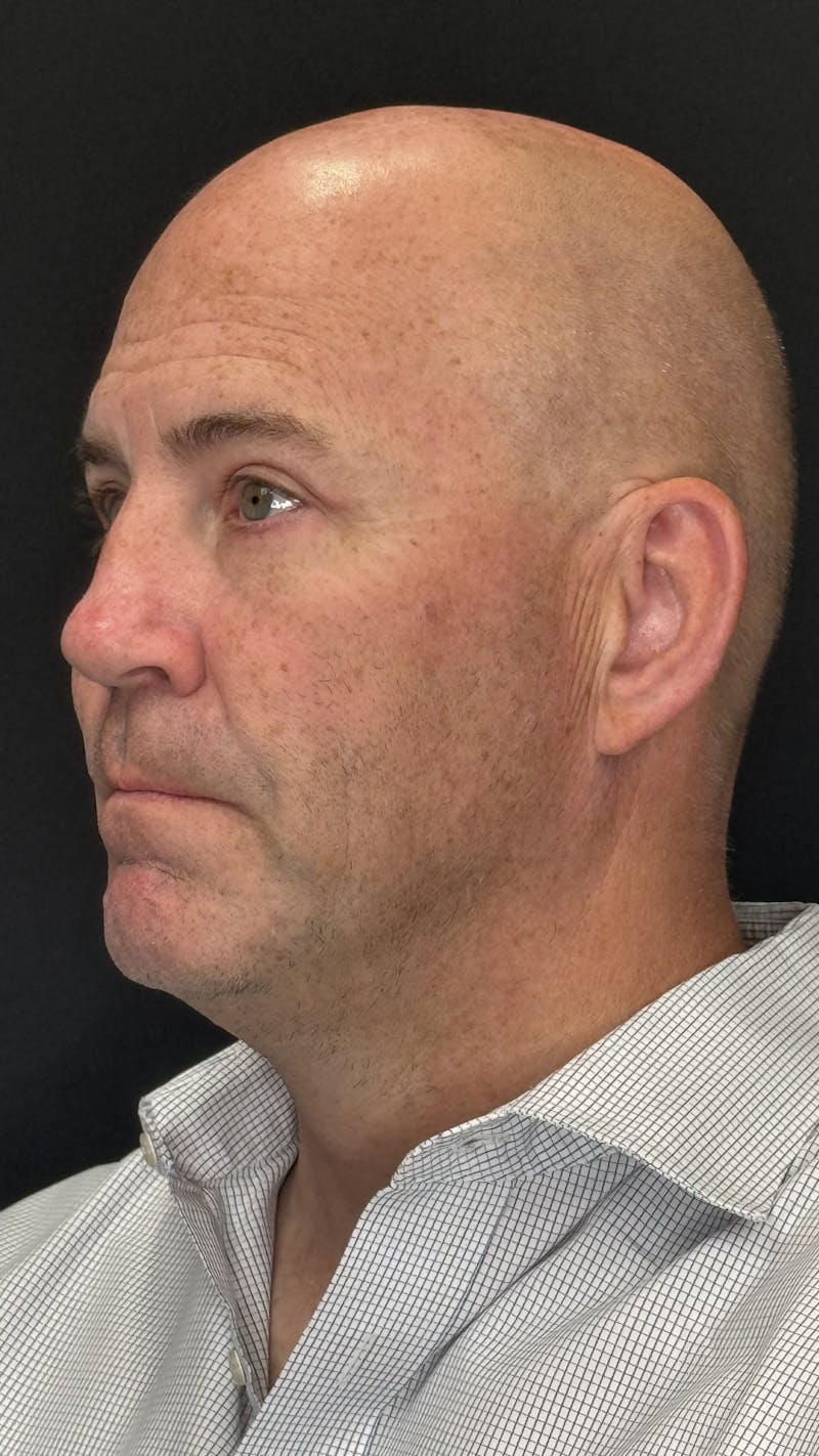 Lower Eye Rejuvenation Before & After Gallery - Patient 262198 - Image 6
