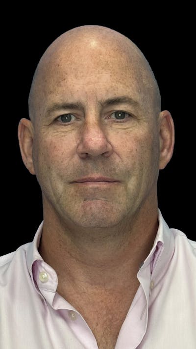 Lower Eye Rejuvenation Before & After Gallery - Patient 262198 - Image 1