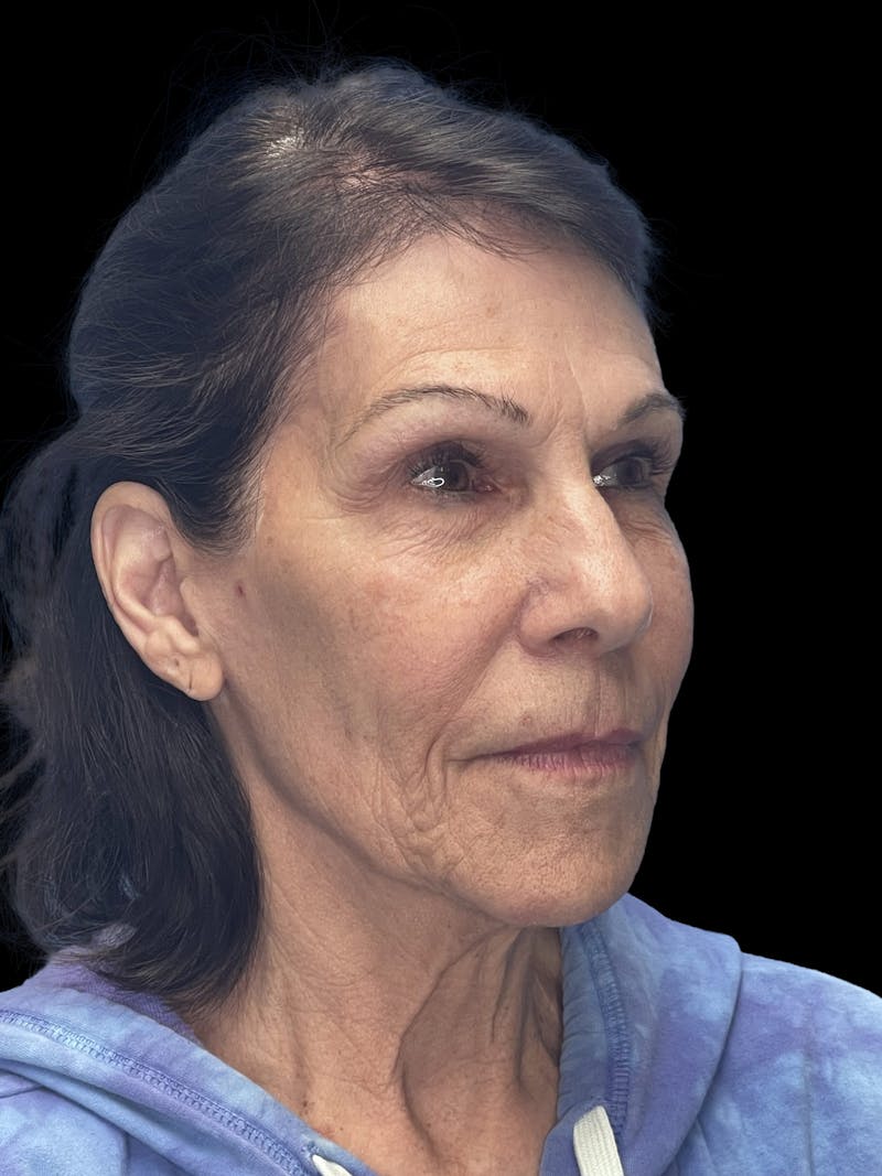 Laser Skin Resurfacing Before & After Gallery - Patient 349800 - Image 1