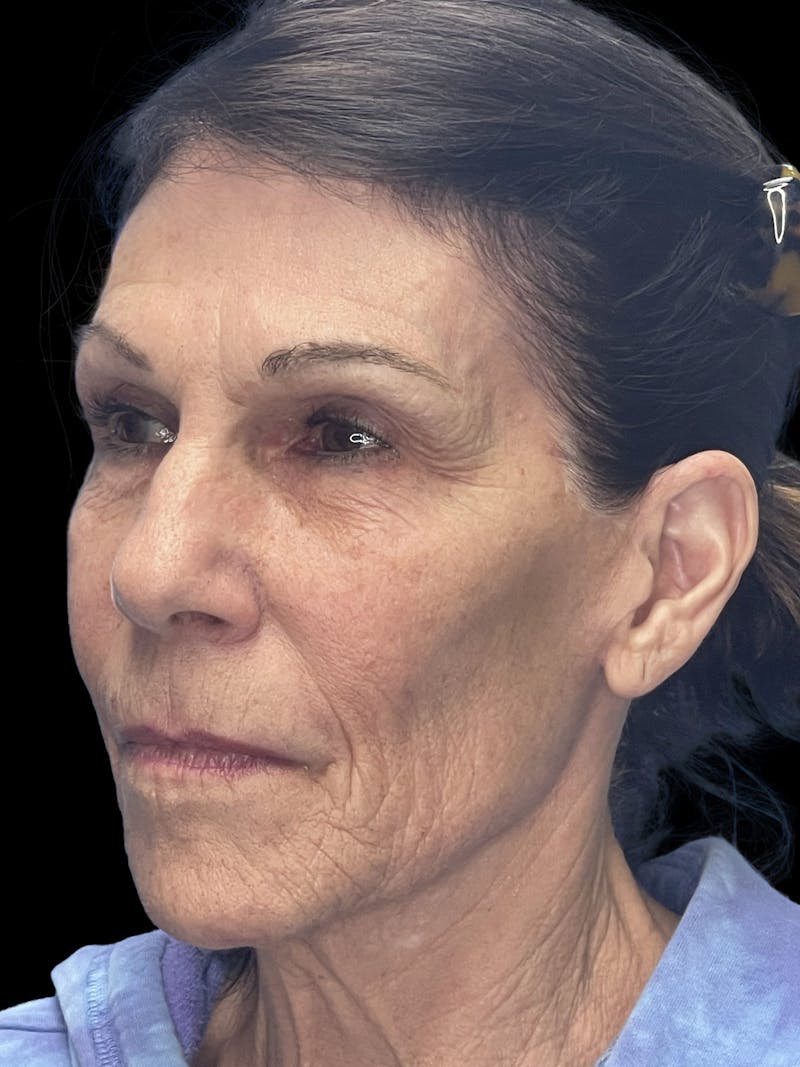 Laser Skin Resurfacing Before & After Gallery - Patient 349800 - Image 3