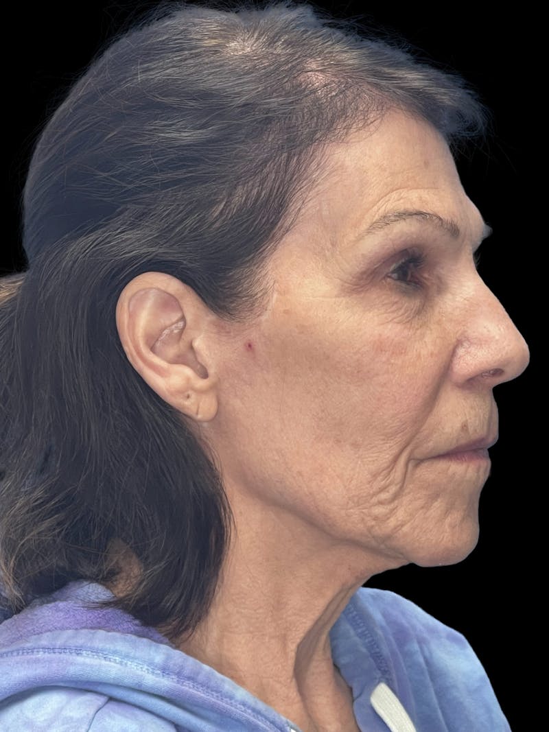 Laser Skin Resurfacing Before & After Gallery - Patient 349800 - Image 5