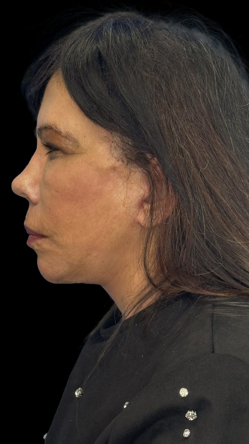 Deep Plane Facelift 70s Before & After Gallery - Patient 363827 - Image 9