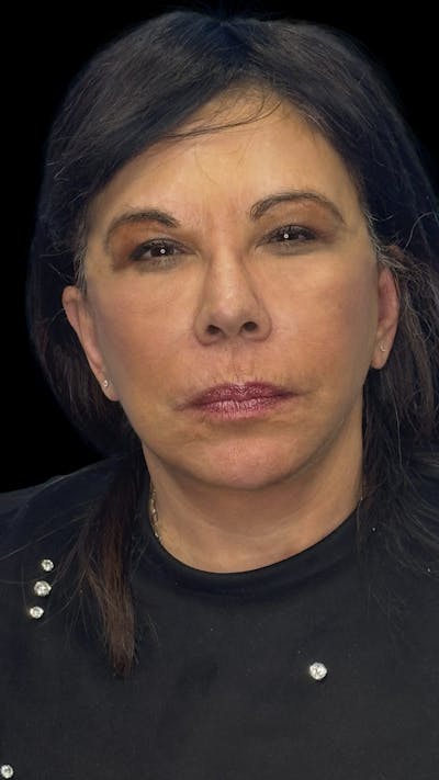 Deep Plane Facelift 70s Before & After Gallery - Patient 363827 - Image 1